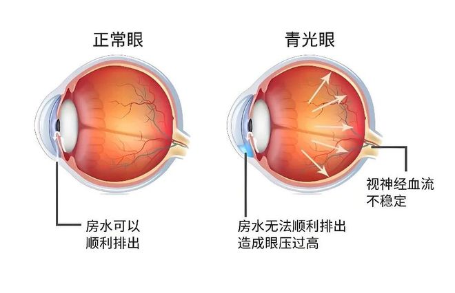 腊八安康冷天气爱找上门的眼病你知道有哪些吗？(图2)