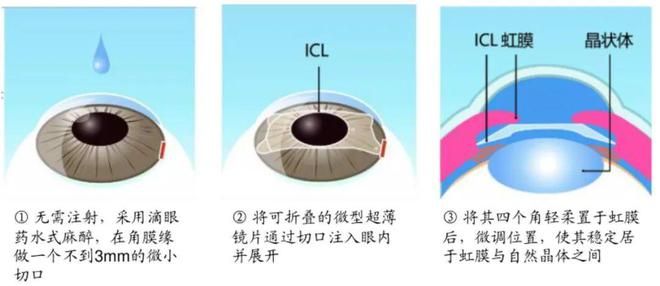 挤进国内唯三！眼科巨头如何打破进口垄断？(图1)